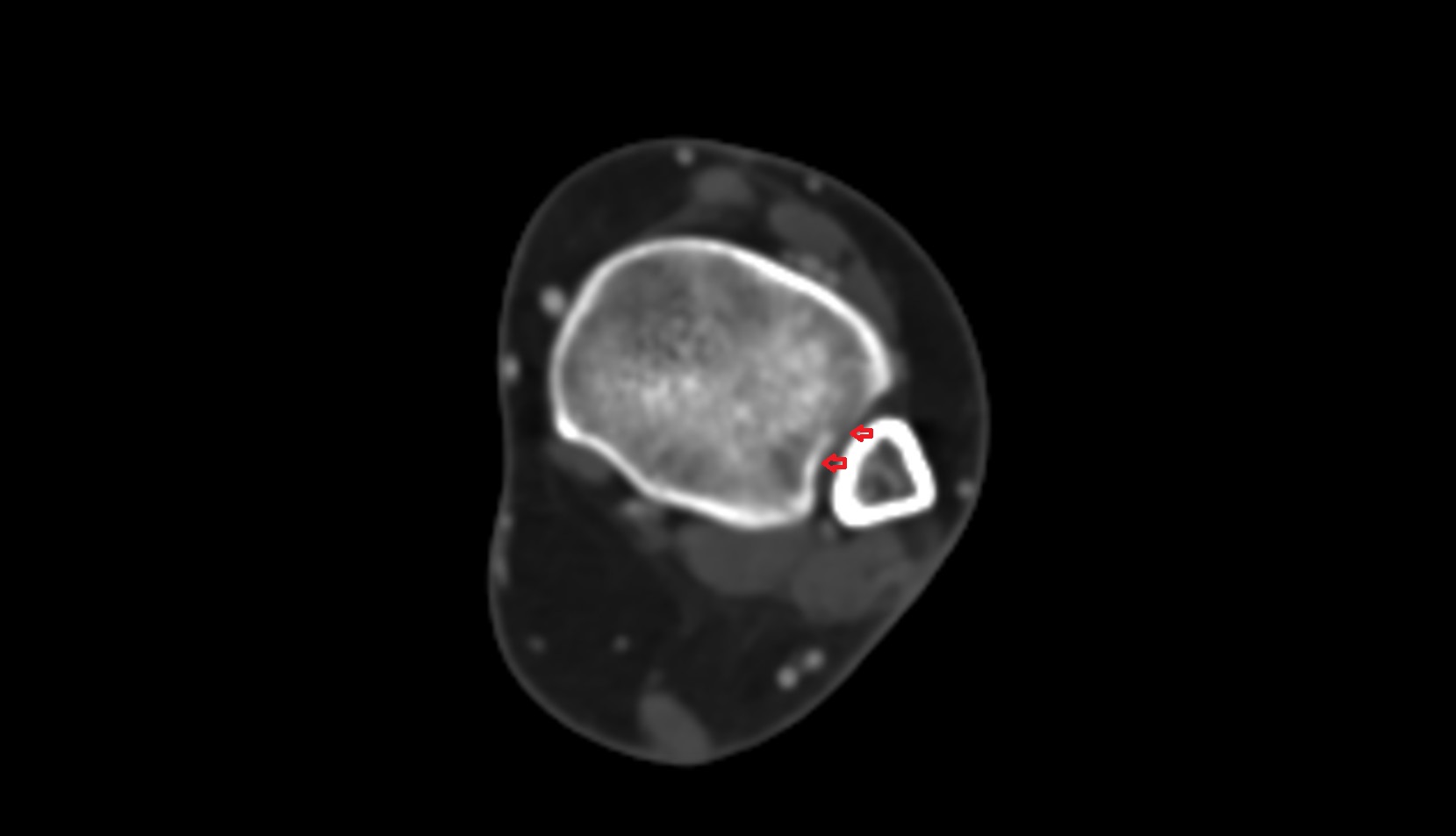 Fibular notch of tibia axial ct