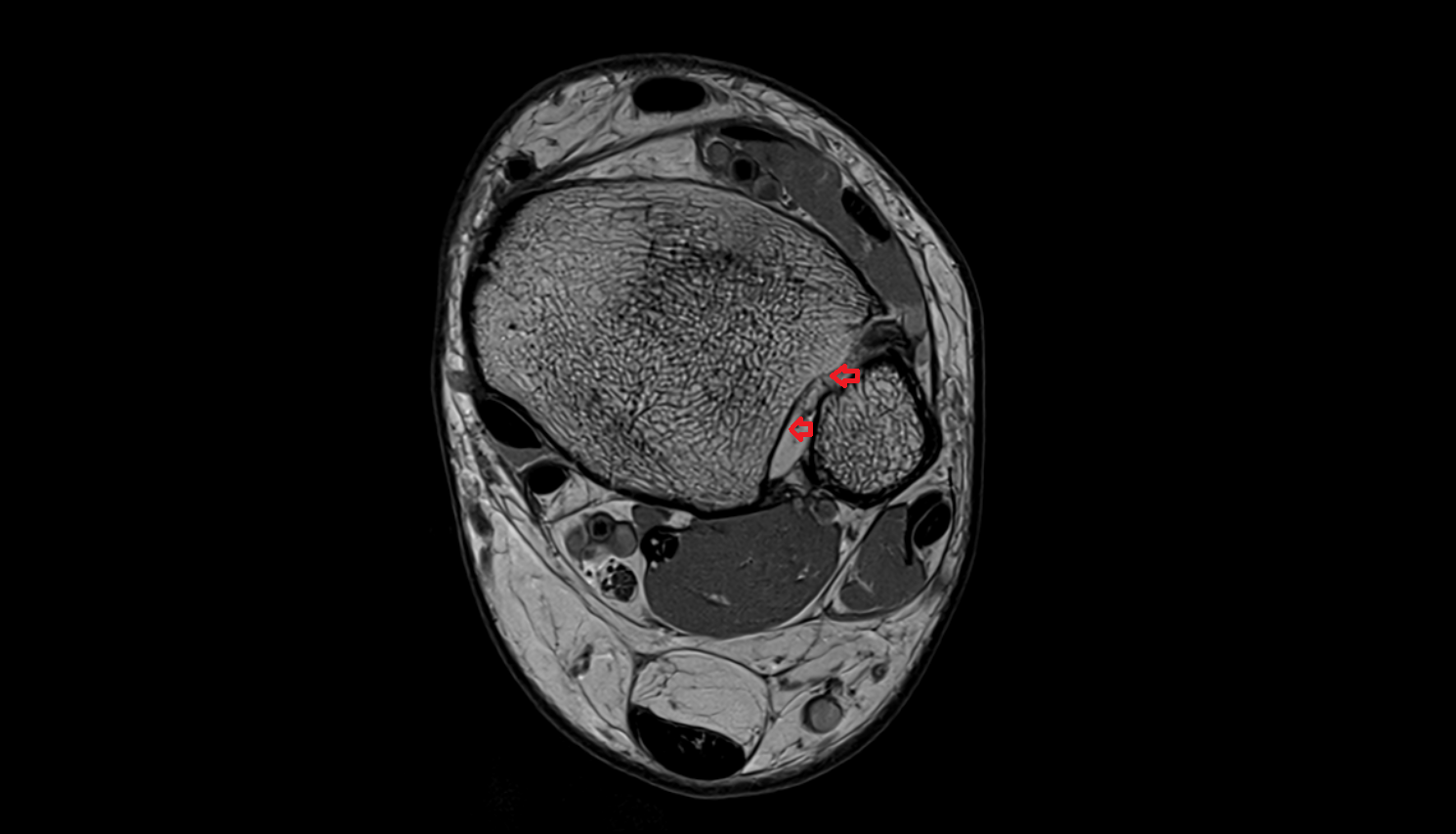 Fibular notch of tibia mri  anatomy labelled image-img-00000-00000