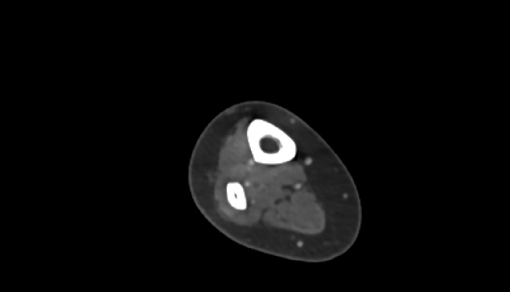 Fibular (peroneal) artery CT AXIAL image  2