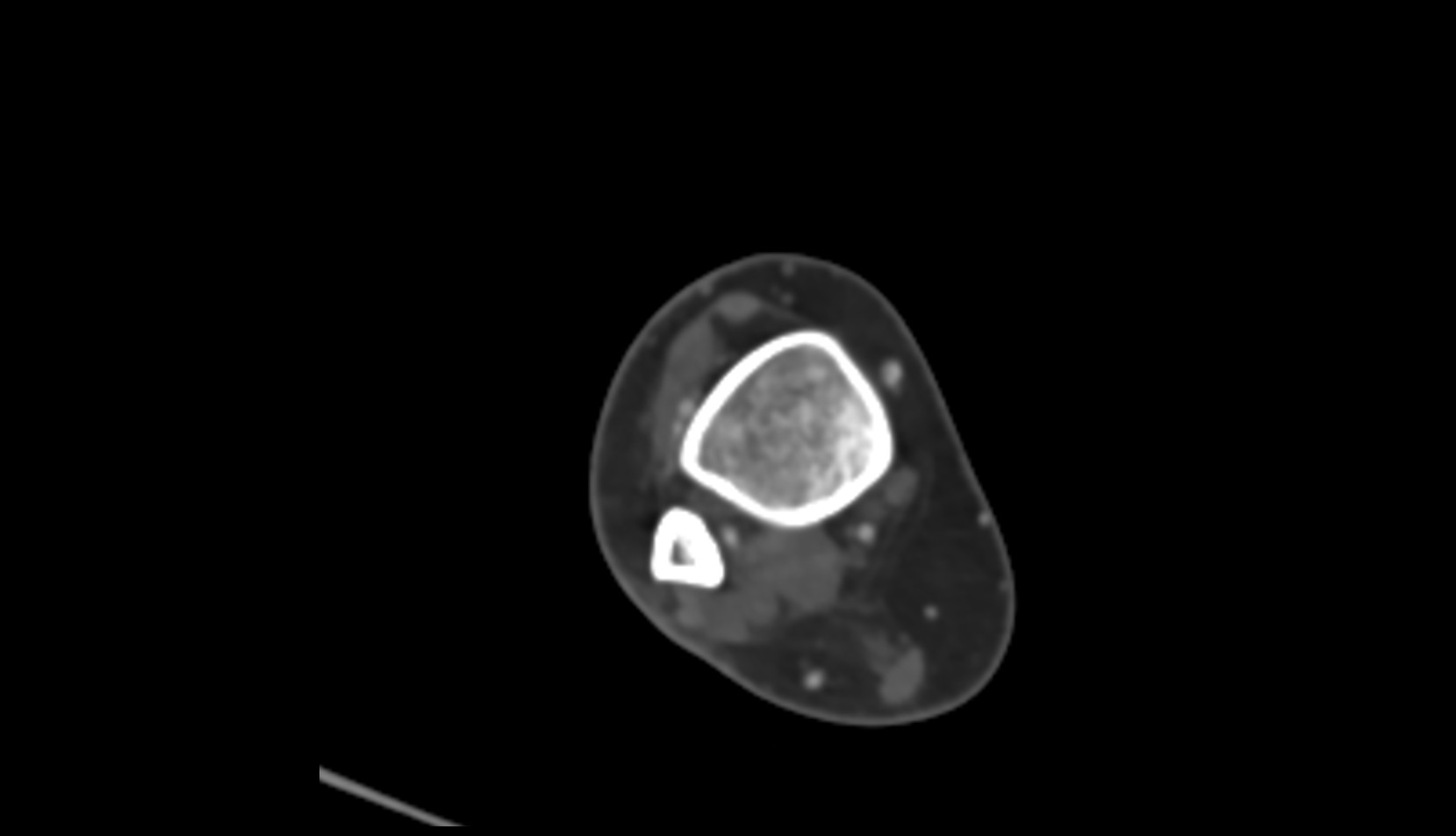 Fibular (peroneal) artery CT AXIAL image 3
