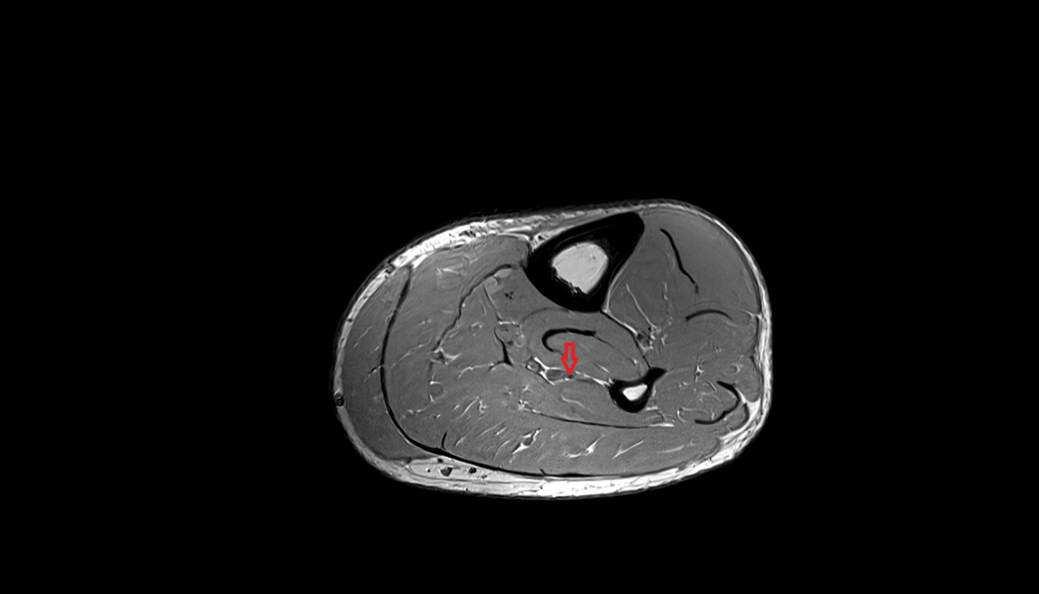 Fibular (peroneal) artery   axial  cross sectional anatomy 3T MRI AI enhanced radiology image-img-00000-00000_00001