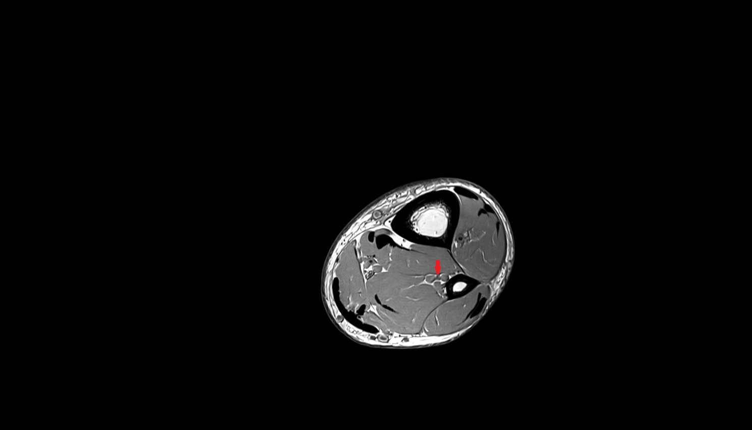 Fibular (peroneal) artery   axial  cross sectional anatomy 3T MRI AI enhanced radiology image-img-00000-00000_00002