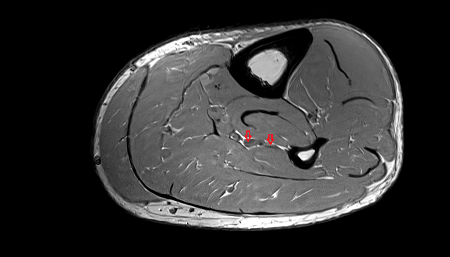 Fibular (peroneal) veins axial  cross sectional anatomy 3T MRI AI enhanced radiology image-img-00000-00000