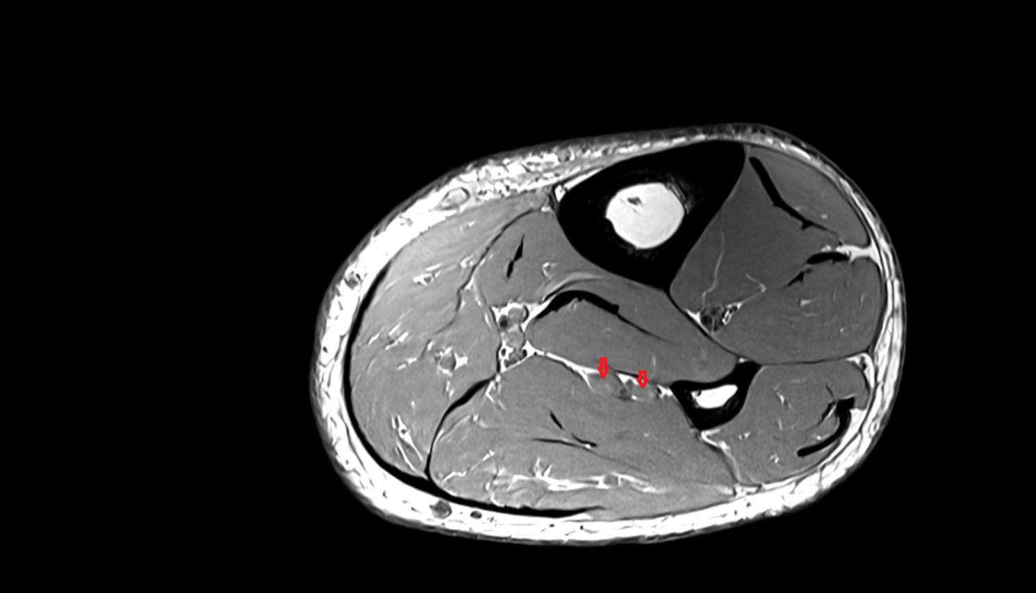 Fibular (peroneal) veins axial  cross sectional anatomy 3T MRI AI enhanced radiology image-img-00000-00000_00001