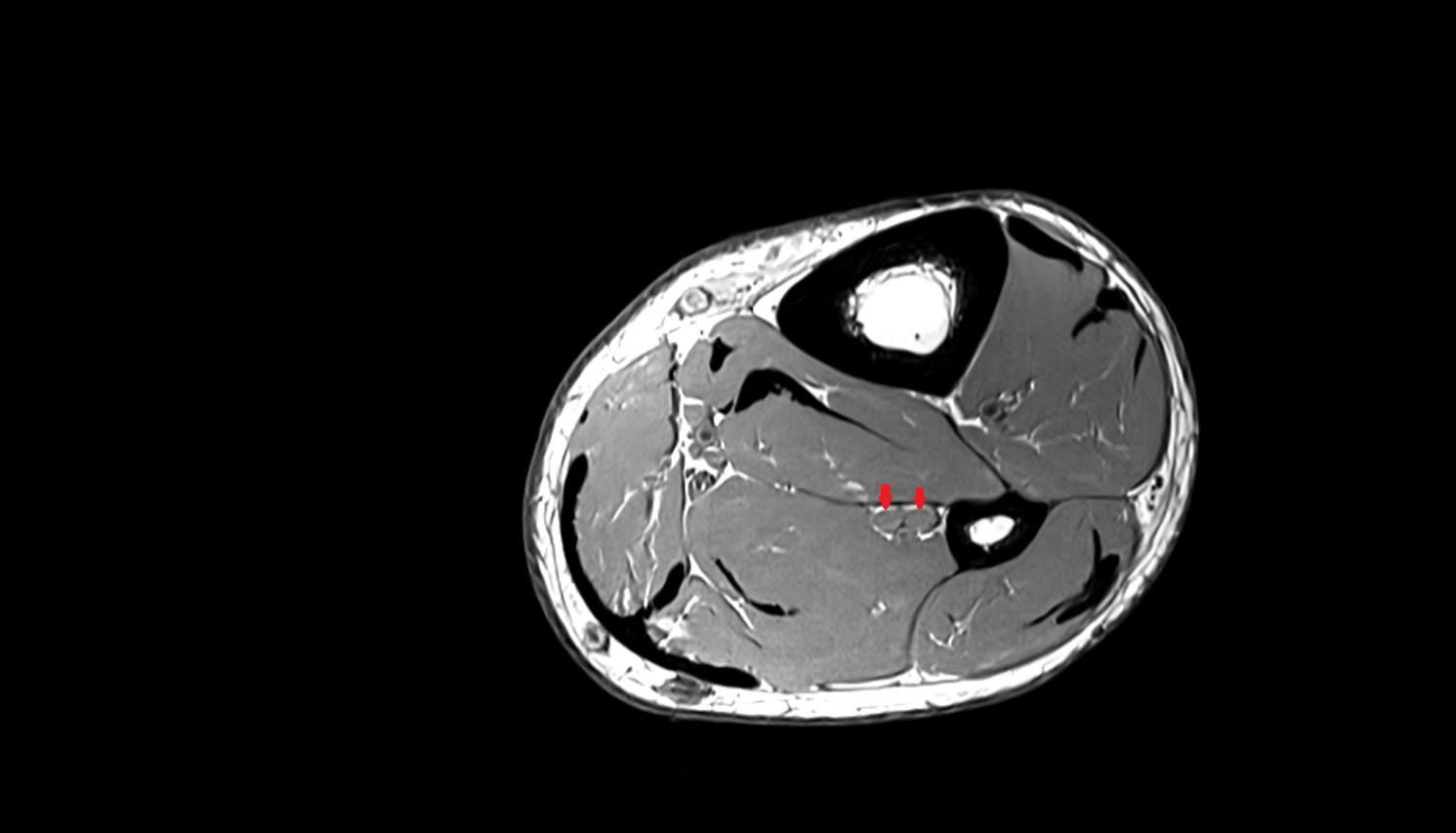 Fibular (peroneal) veins axial  cross sectional anatomy 3T MRI AI enhanced radiology image-img-00000-00000_00002