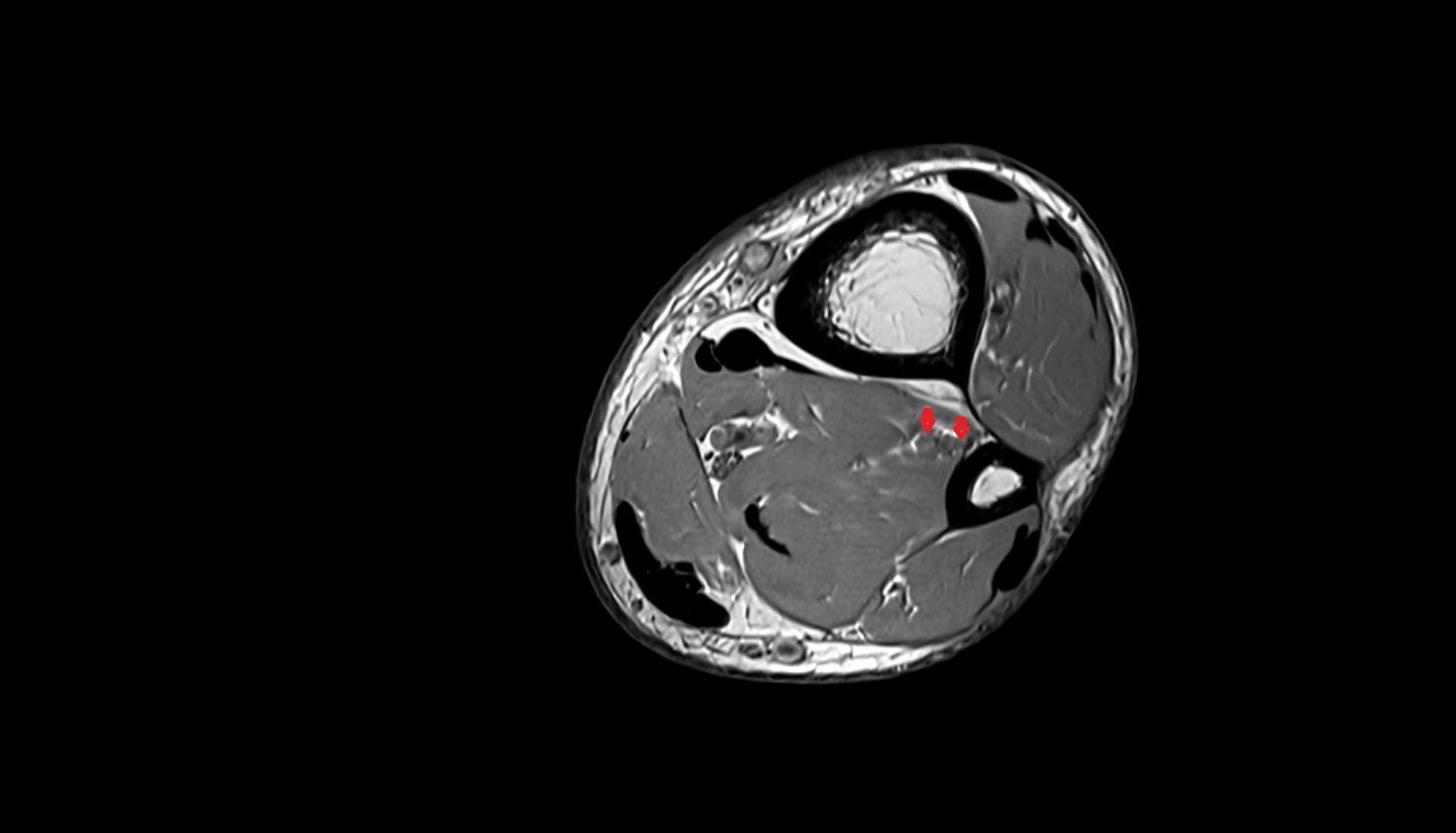 Fibular (peroneal) veins axial  cross sectional anatomy 3T MRI AI enhanced radiology image-img-00000-00000_00003