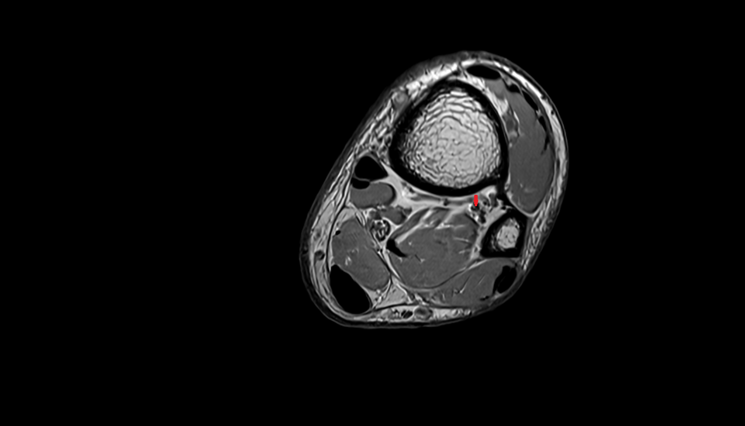 Fibular (peroneal) veins axial  cross sectional anatomy 3T MRI AI enhanced radiology image-img-00000-00000_00004