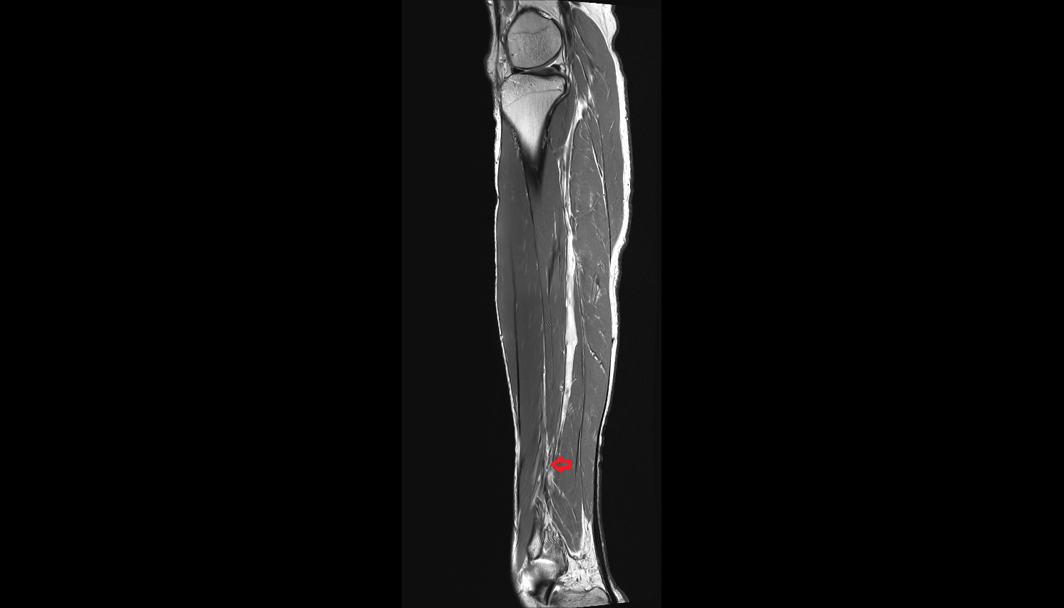 Fibular (peroneal) veins  sag  cross sectional anatomy 3T MRI AI enhanced radiology image-img-00000-00000