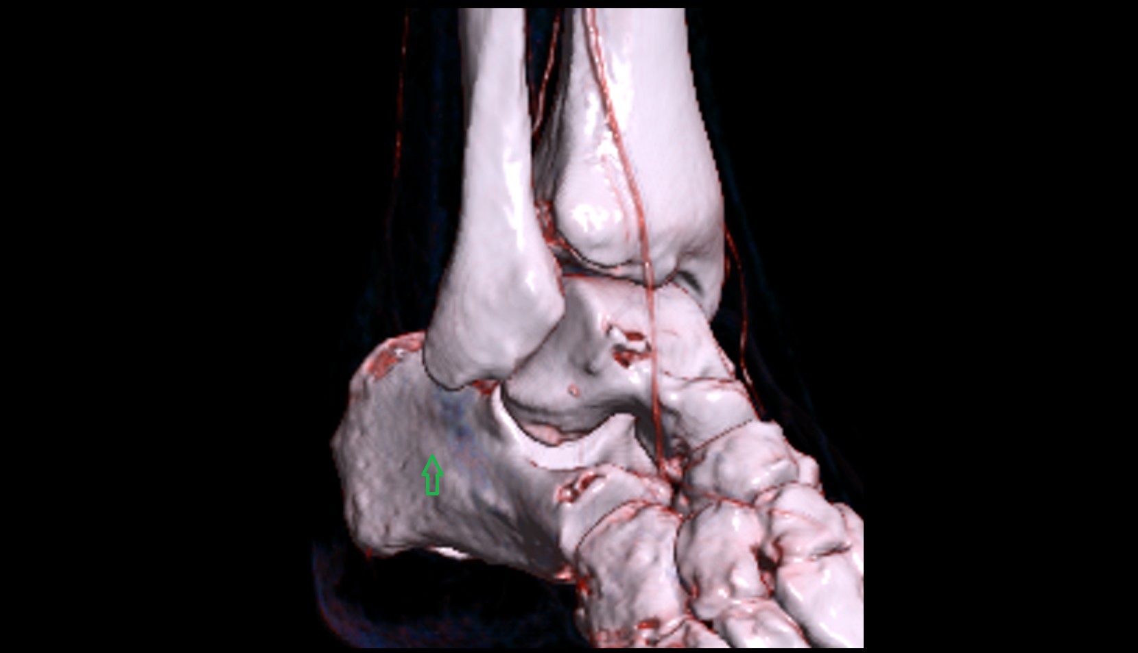 Fibular trochlea 3d image