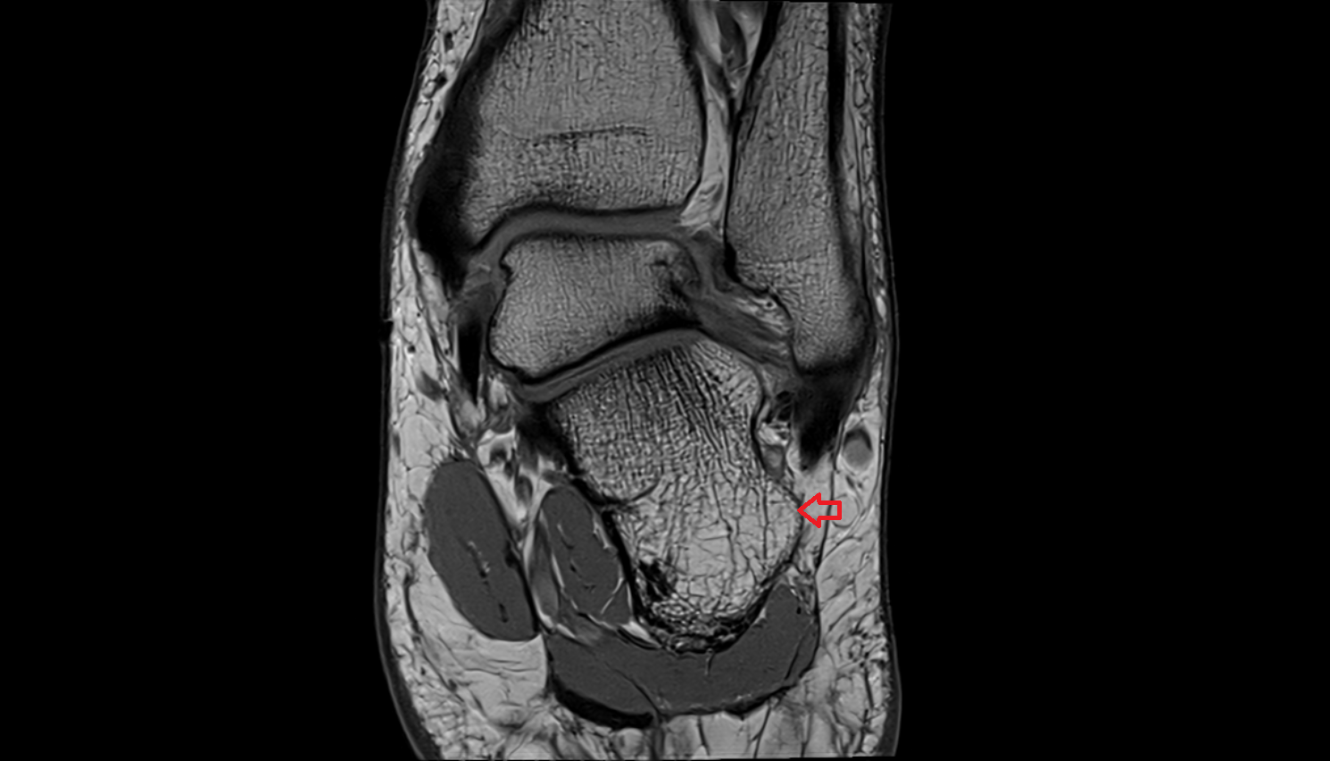 Fibular trochlea  mri  anatomy labelled image-img-00000-00000