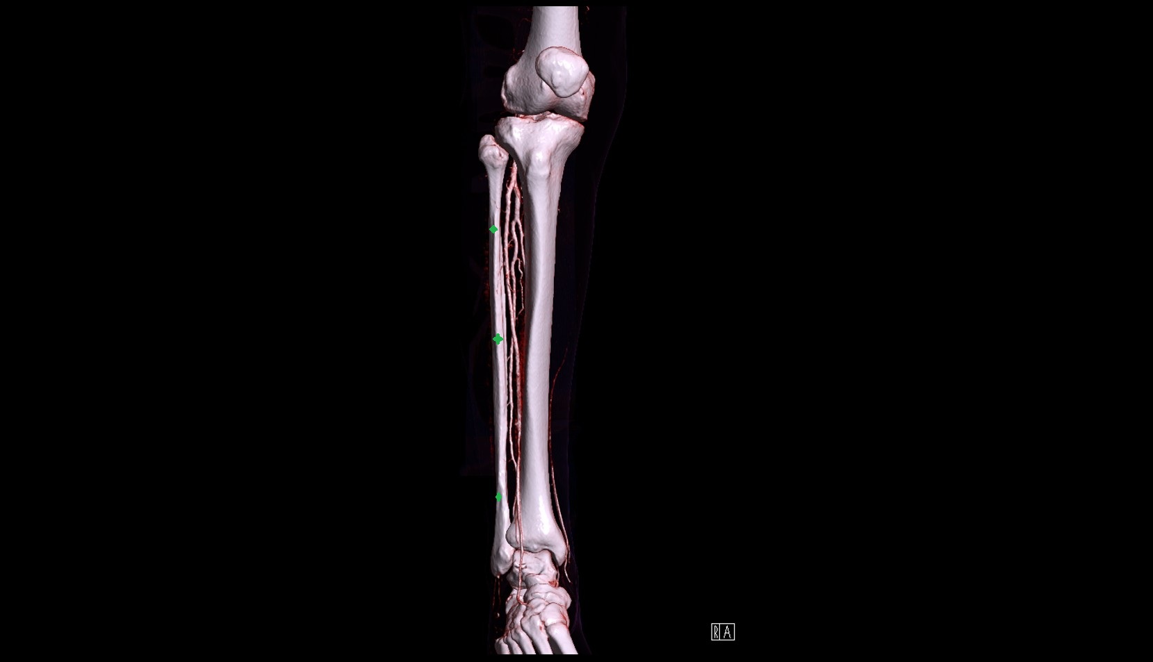 Fibula shaft 3d