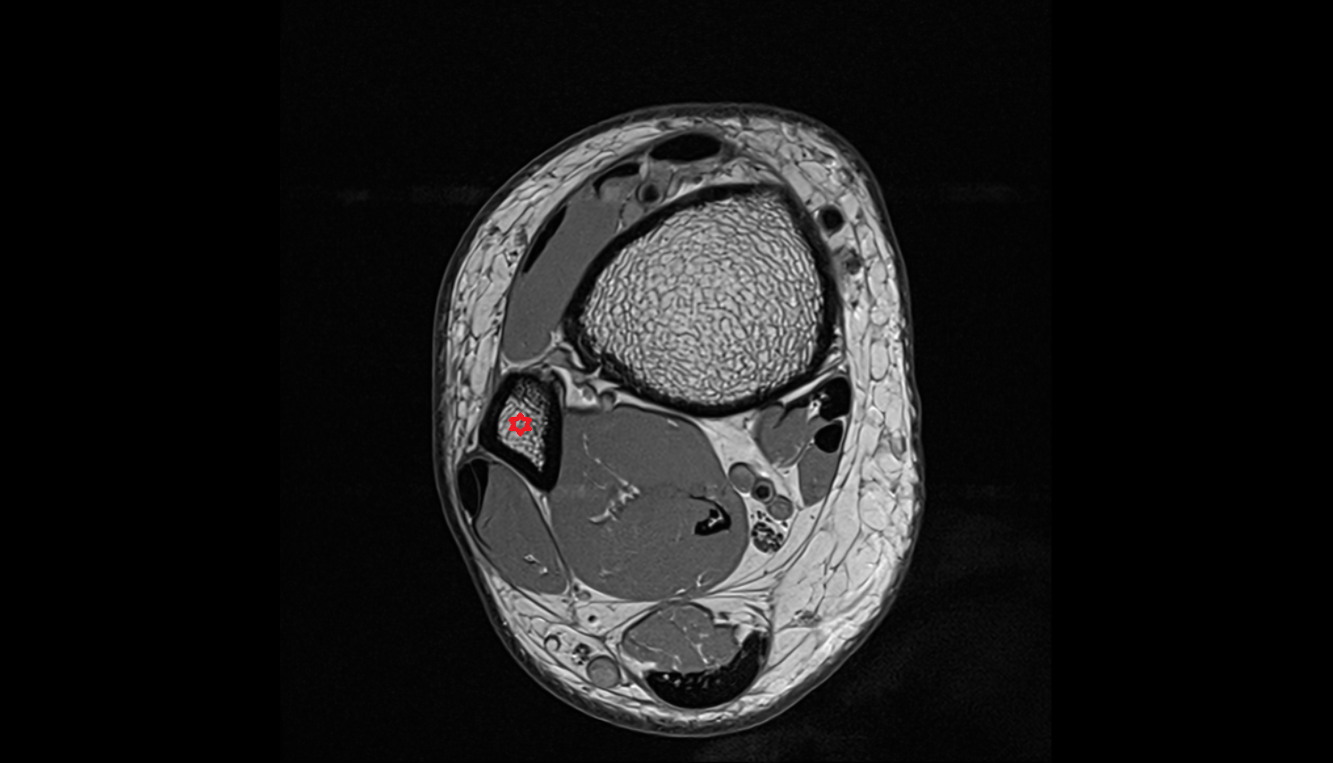 Fibula shaft  MRI axial  cross sectional anatomy 3T MRI AI enhanced radiology image-img-00000-00000