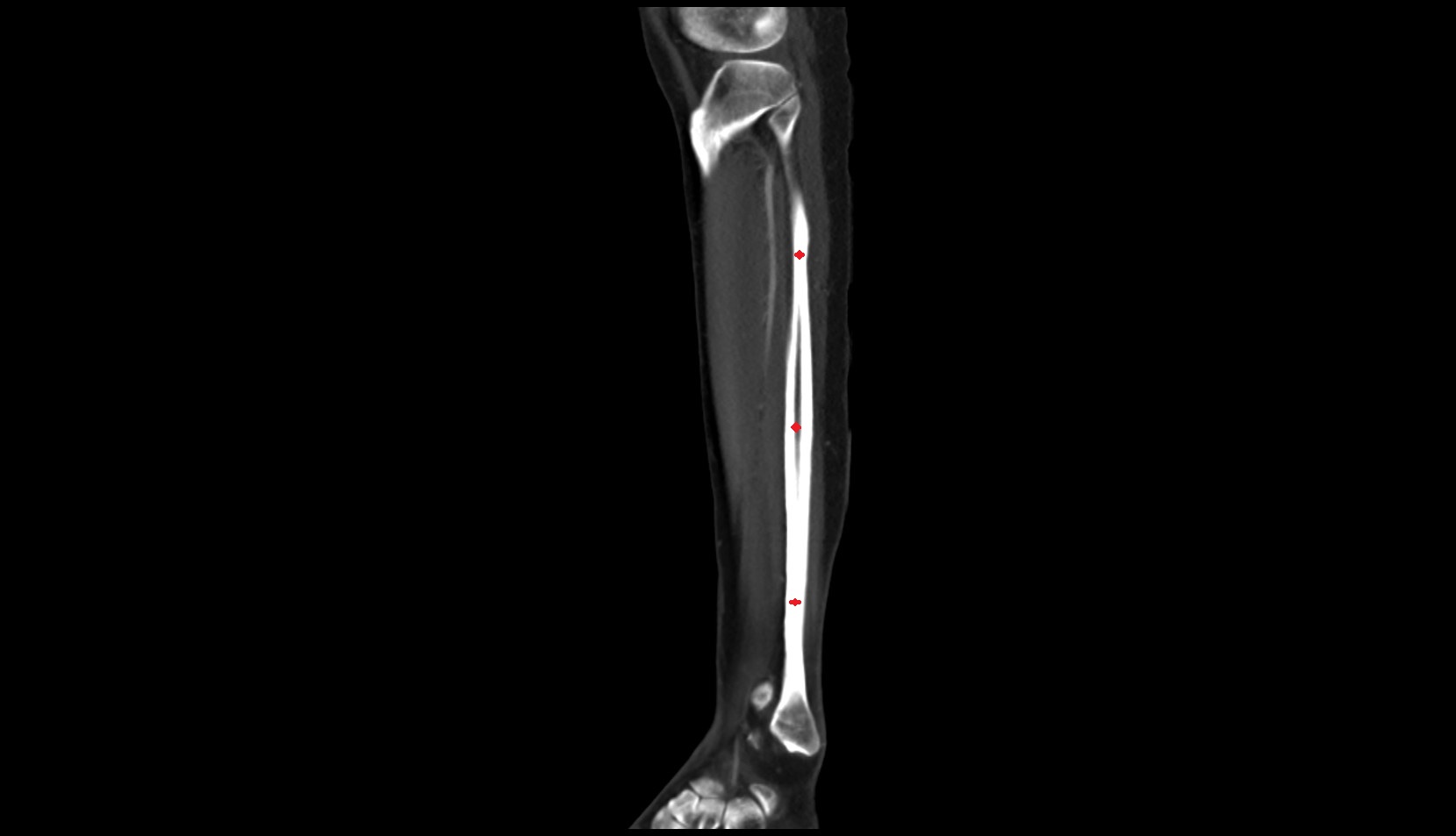 Fibula shaft ct sagittal image