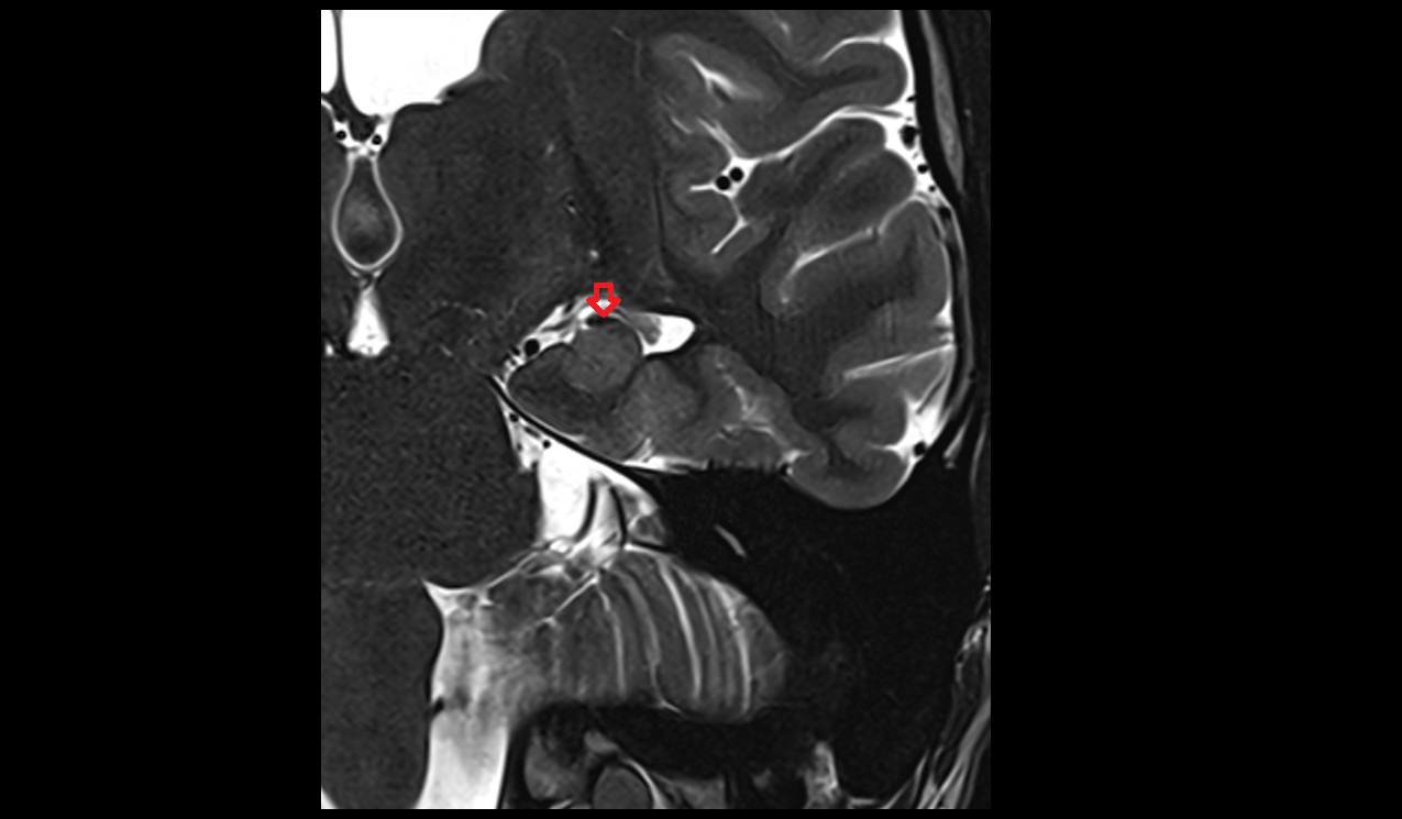 Fimbria of hippocampus mri 3t coronal image