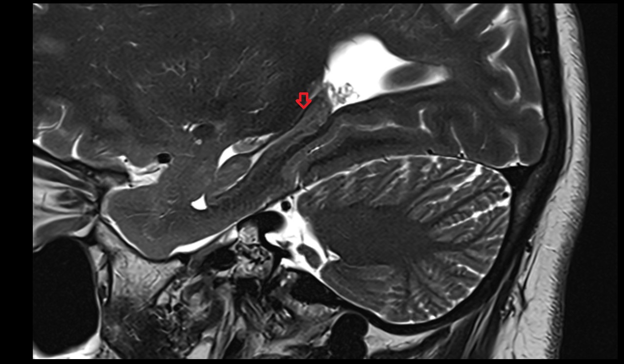 Fimbria of hippocampus mri 3t sagittal image