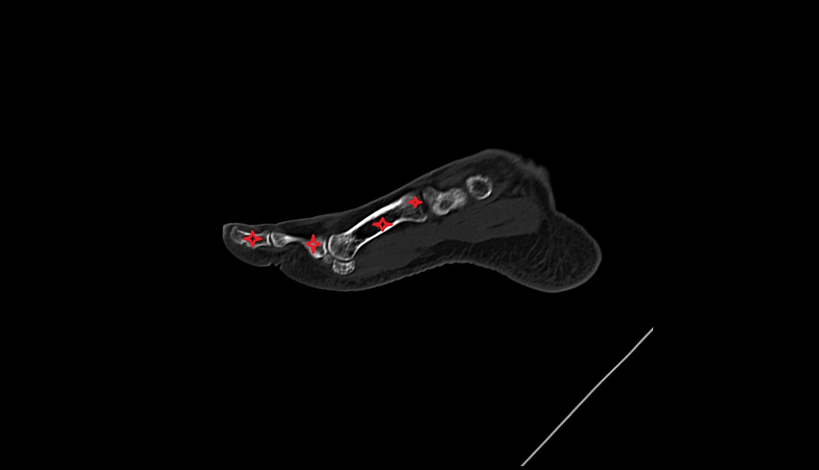 First Toe (Hallux) ct sagittal image