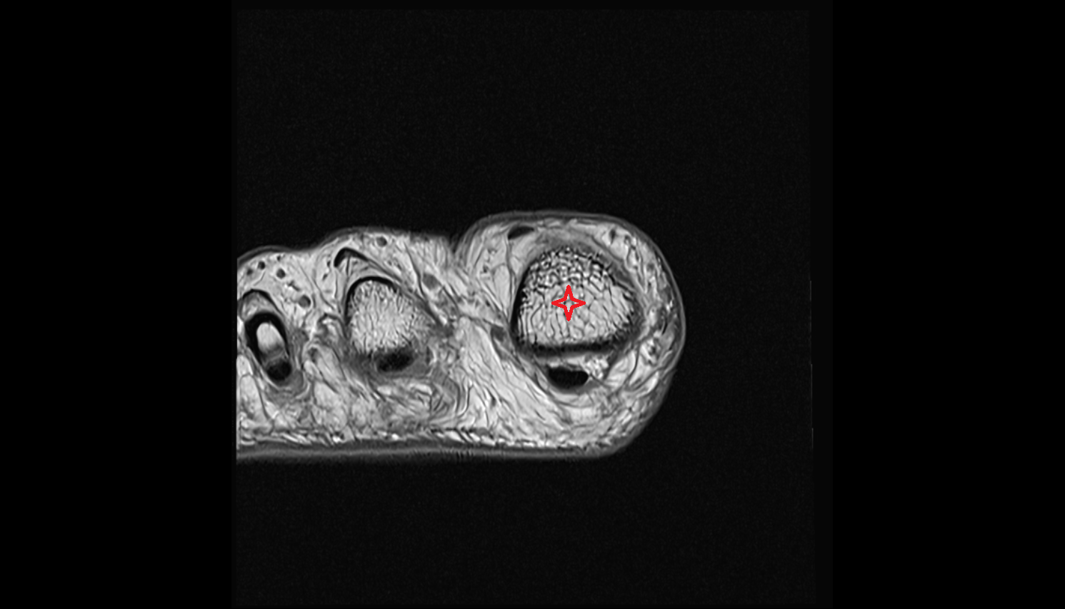 First Toe (Hallux) of foot axiall cross sectional anatomy 3T MRI AI enhanced radiology image-img-00000-00000