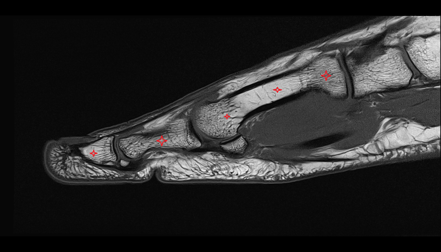 First Toe (Hallux) of foot axiall cross sectional anatomy 3T MRI AI enhanced radiology image-img-00000-00000_00001