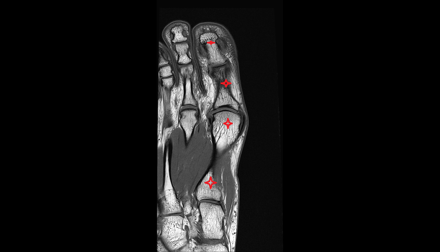 First Toe (Hallux) of foot coronal cross sectional anatomy 3T MRI AI enhanced radiology image-img-00000-00000