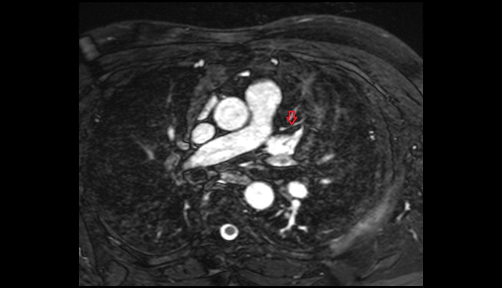 First diagonal branch (D1) of LAD mri axial image