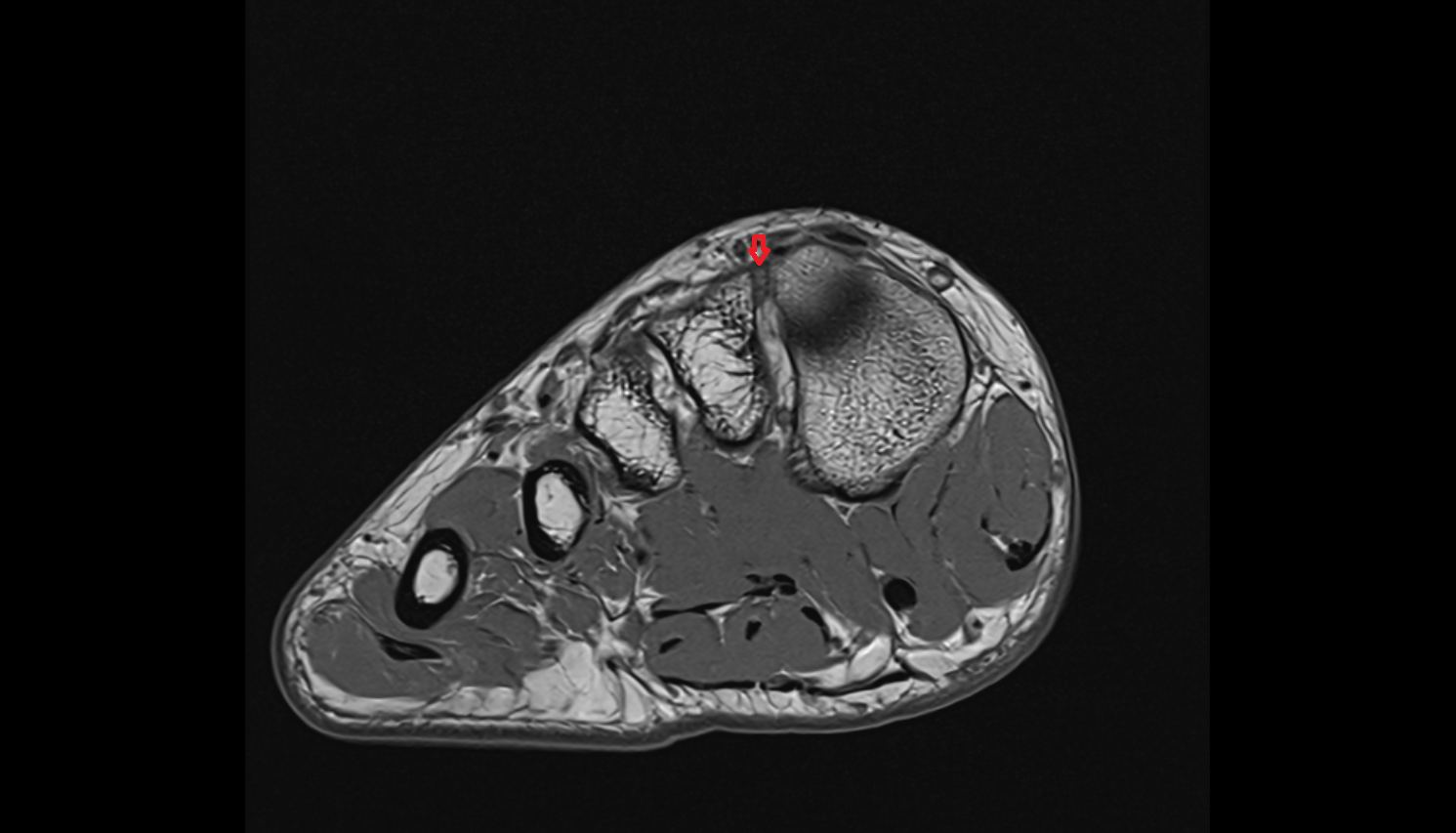 First dorsal cuneometatarsal  ligament (Dorsal Lisfranc Ligament) axial cross sectional anatomy 3T MRI AI enhanced radiology image-img-00000-00000