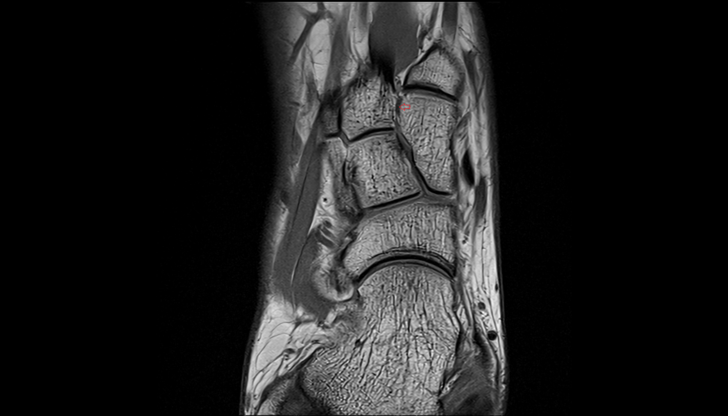 First dorsal cuneometatarsal  ligament (Dorsal Lisfranc Ligament) coronall cross sectional anatomy 3T MRI AI enhanced radiology image-img-00000-00000