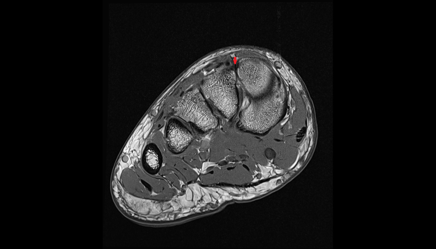 First dorsal cuneometatarsal  ligament (Dorsal Lisfranc Ligament) coronall cross sectional anatomy 3T MRI AI enhanced radiology image-img-00000-00000_00001