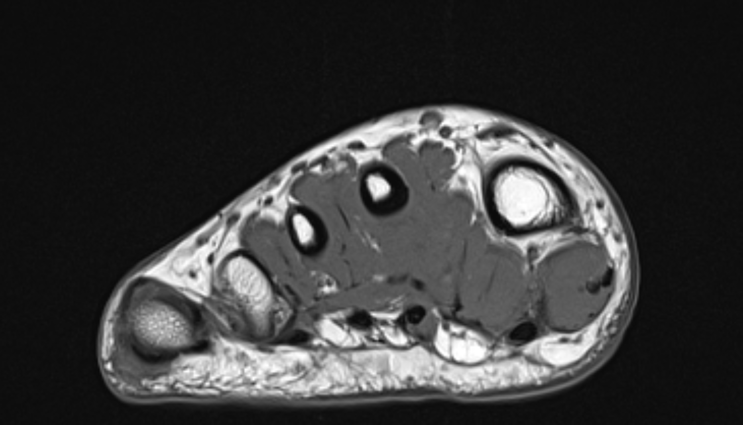 First dorsal interosseous muscle of foot  muscle coronal cross sectional anatomy 3T MRI AI enhanced radiology image-img-00000-00000