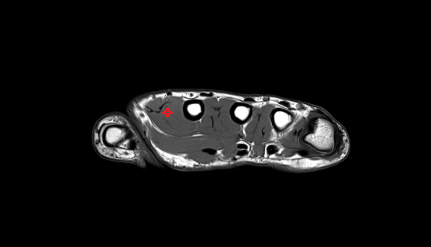 First dorsal interosseous muscle of hand axial cross sectional anatomy 3T MRI AI enhanced radiology image-img-00000-00000_00001