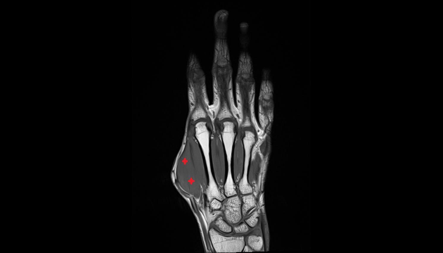 First dorsal interosseous muscle of hand coronal cross sectional anatomy 3T MRI AI enhanced radiology image-img-00000-00000_00001