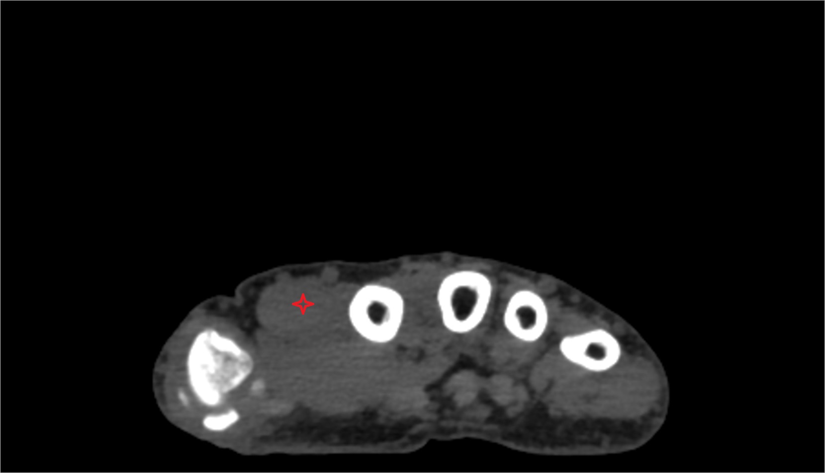 First dorsal interosseous muscle of hand ct axial image