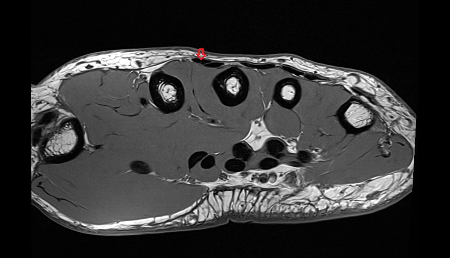 First extensor digitorum tendon (Extensor digitorum tendon to index finger) axial cross sectional anatomy 3T MRI AI enhanced radiology image-img-00000-00000