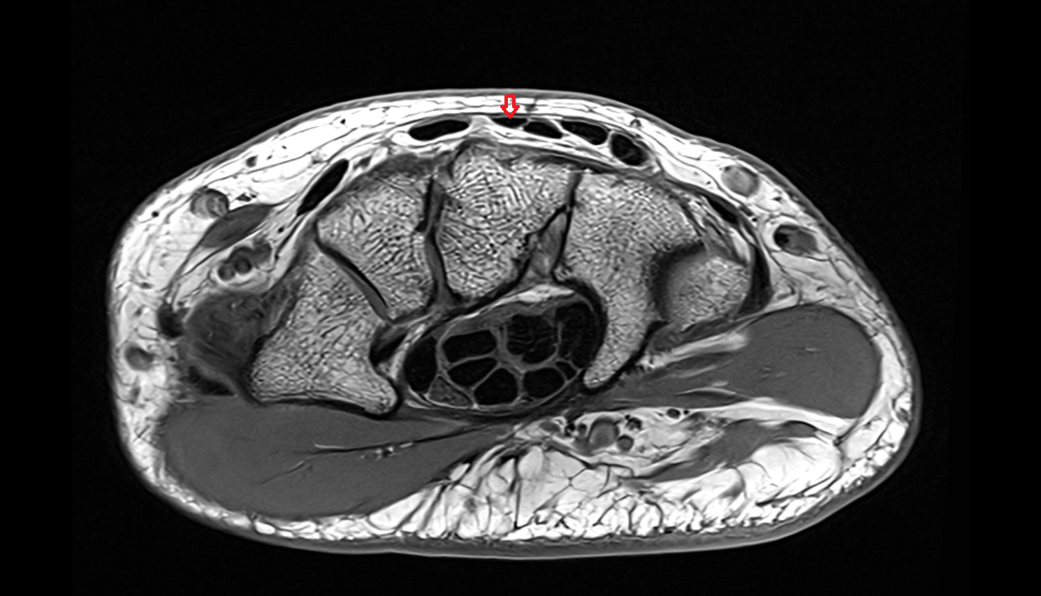 First extensor digitorum tendon (Extensor digitorum tendon to index finger) axial cross sectional anatomy 3T MRI AI enhanced radiology image-img-00000-00000_00001