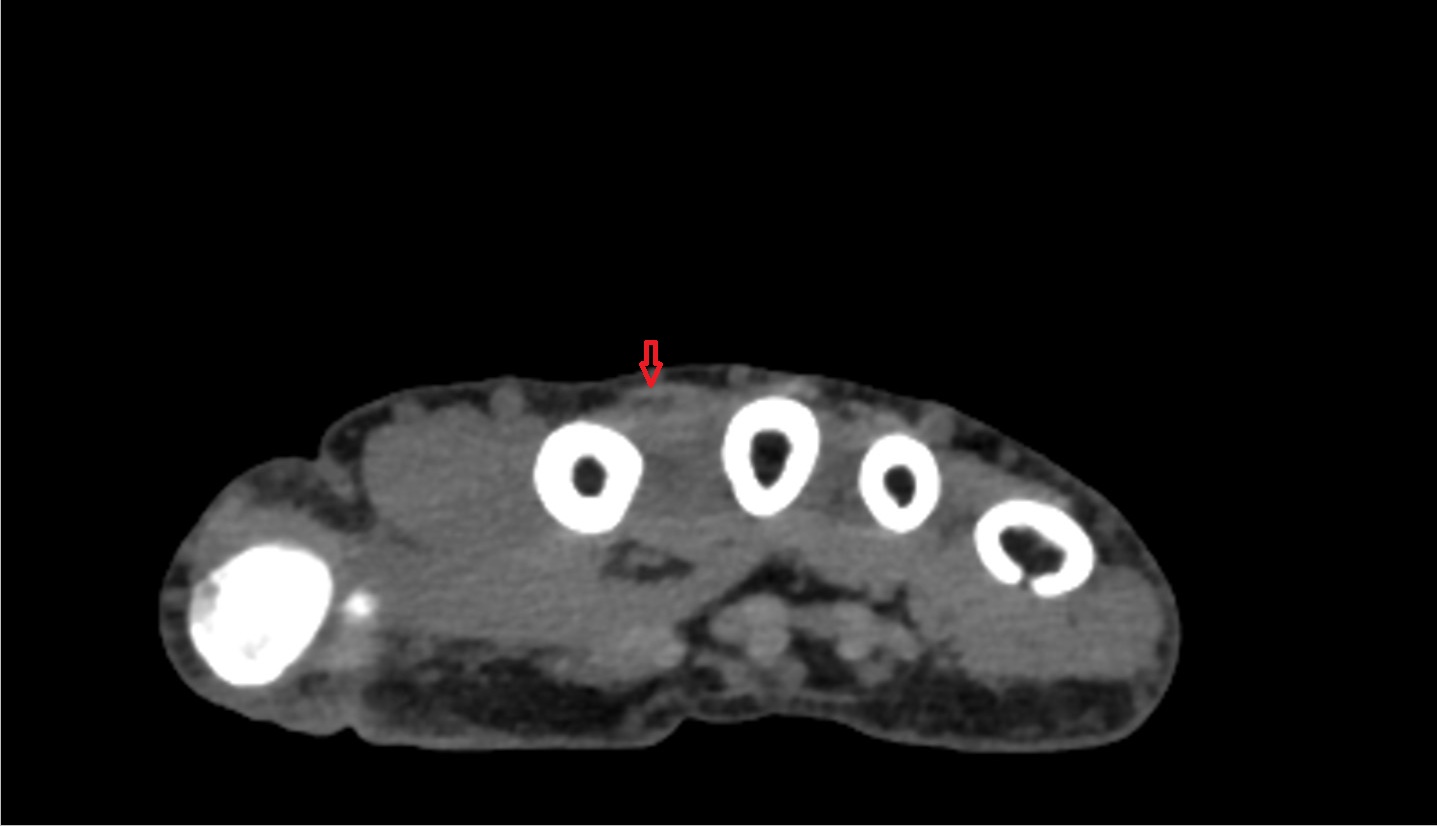First extensor digitorum tendon (Extensor digitorum tendon to index finger) ct axial