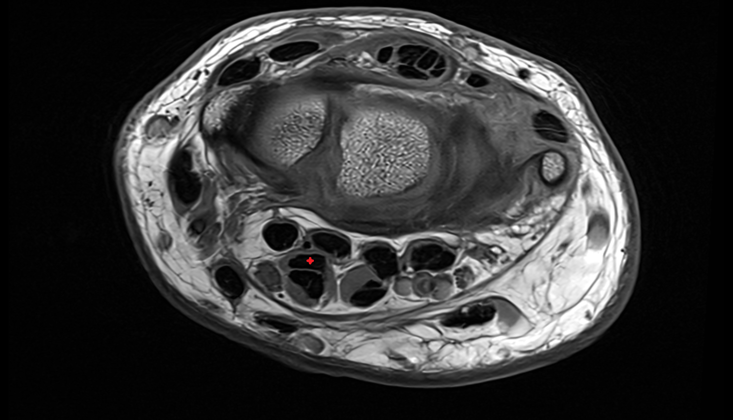 First flexor digitorum superficialis tendon (index) axial cross sectional anatomy 3T MRI AI enhanced radiology image-img-00000-00000_00001
