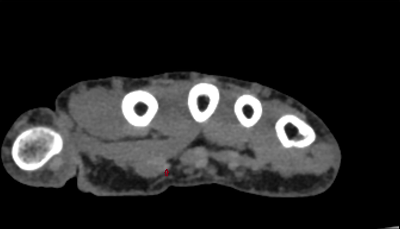First flexor digitorum superficialis tendon (index) ct axial