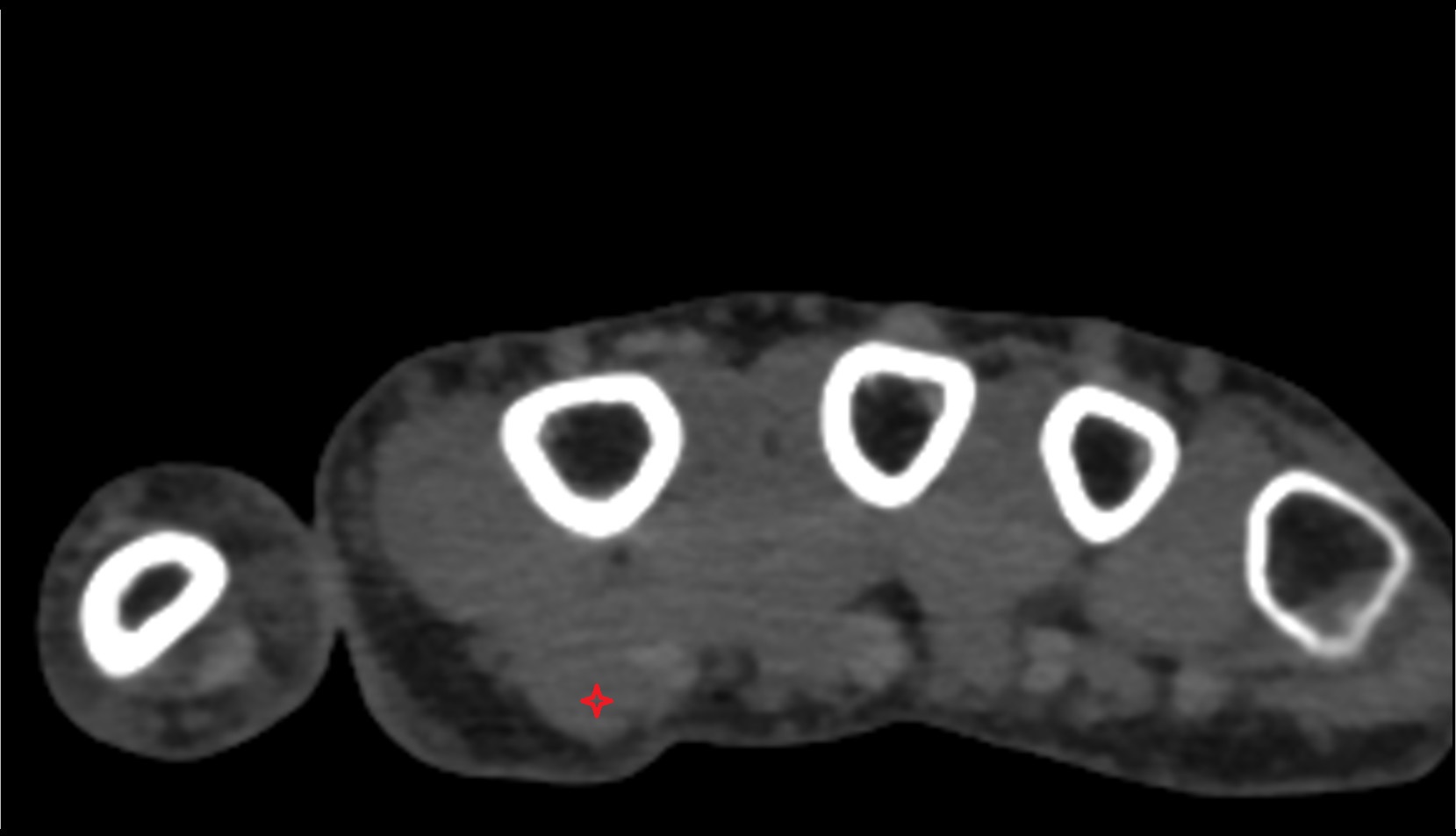 First lumbrical muscle of hand ct axial image