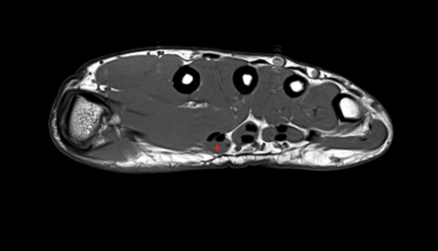First lumbrical  muscle of hand of hand axial cross sectional anatomy 3T MRI AI enhanced radiology image-img-00000-00000