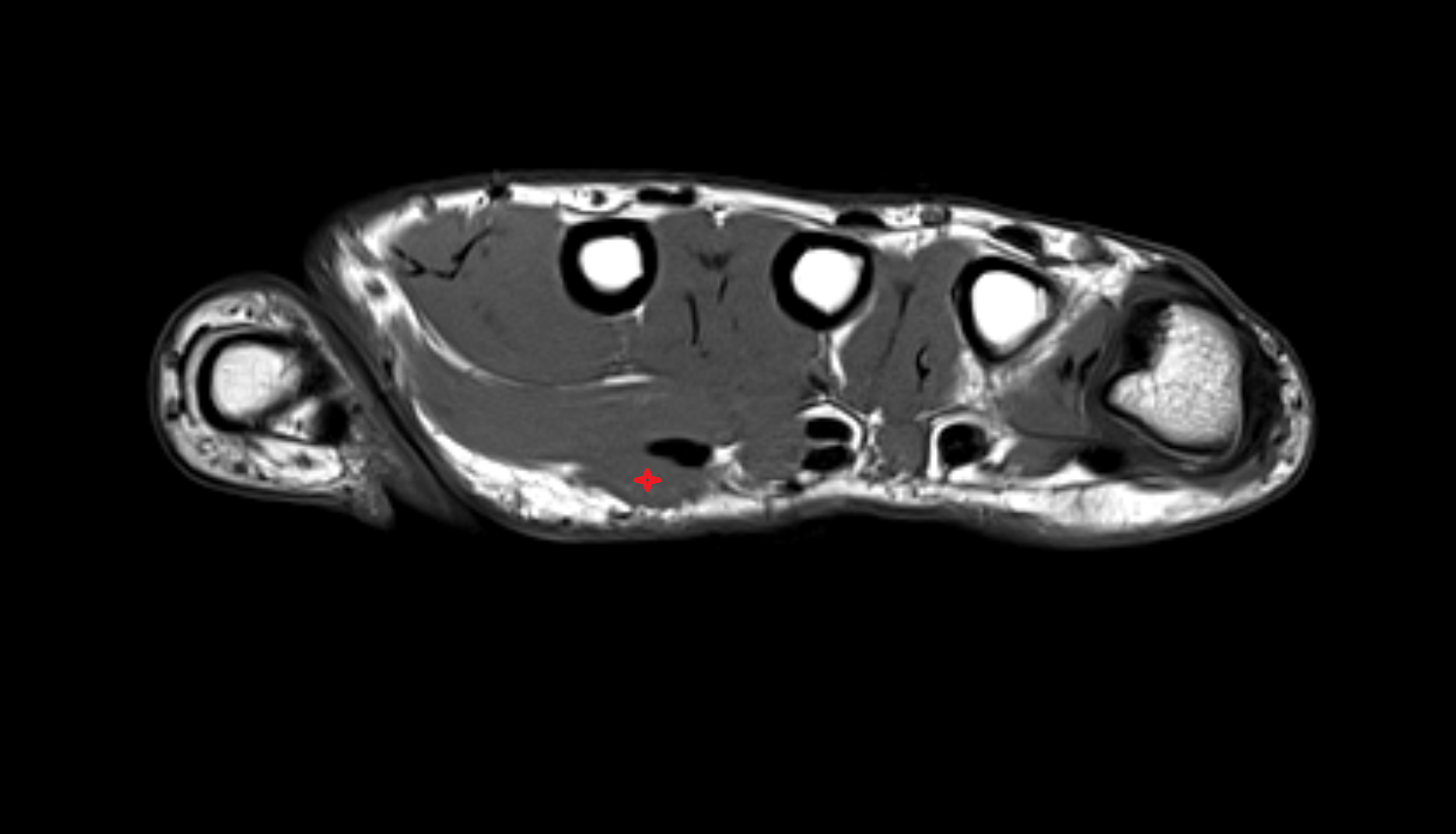 First lumbrical  muscle of hand of hand axial cross sectional anatomy 3T MRI AI enhanced radiology image-img-00000-00000_00001