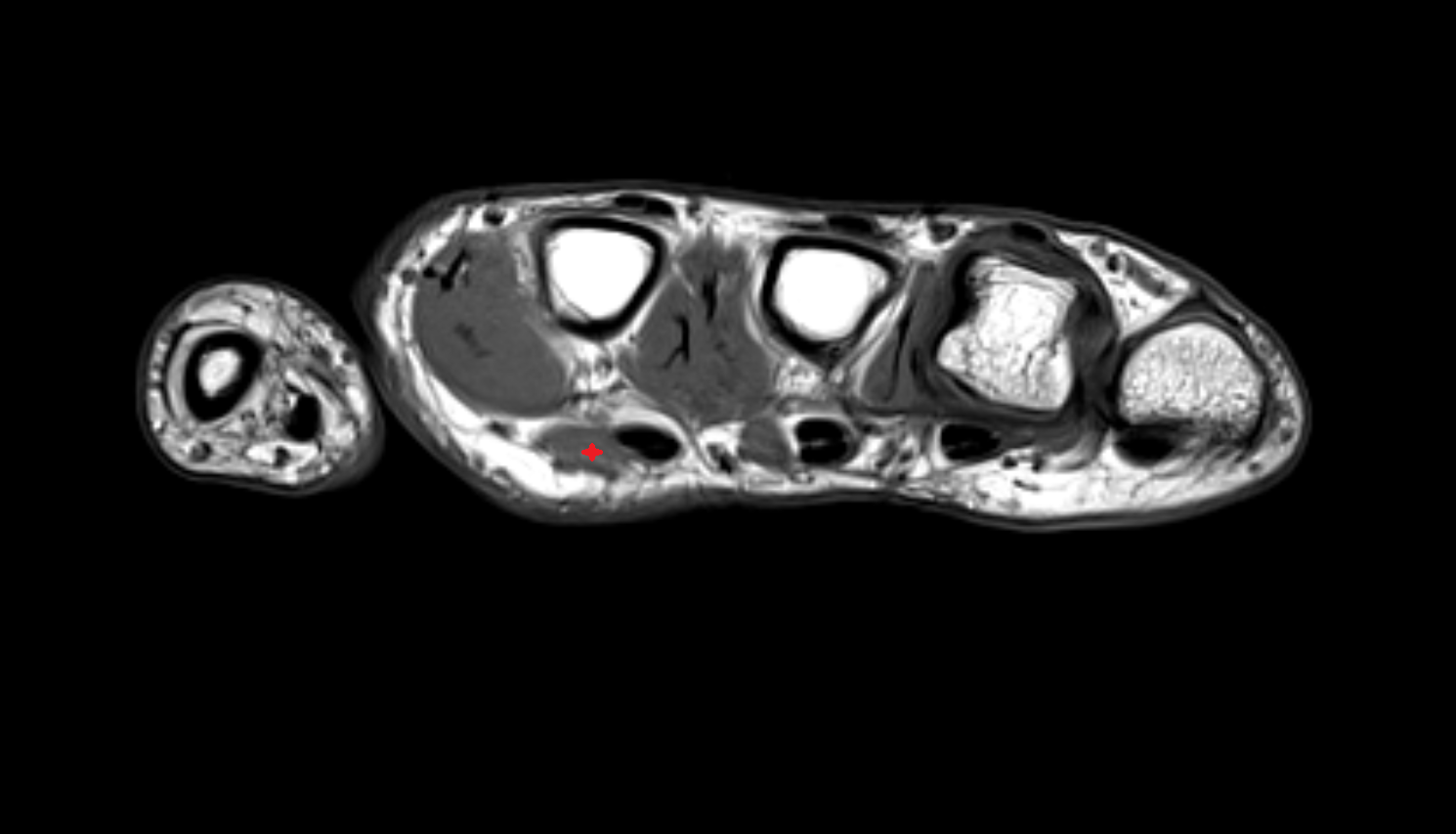 First lumbrical  muscle of hand of hand axial cross sectional anatomy 3T MRI AI enhanced radiology image-img-00000-00000_00002