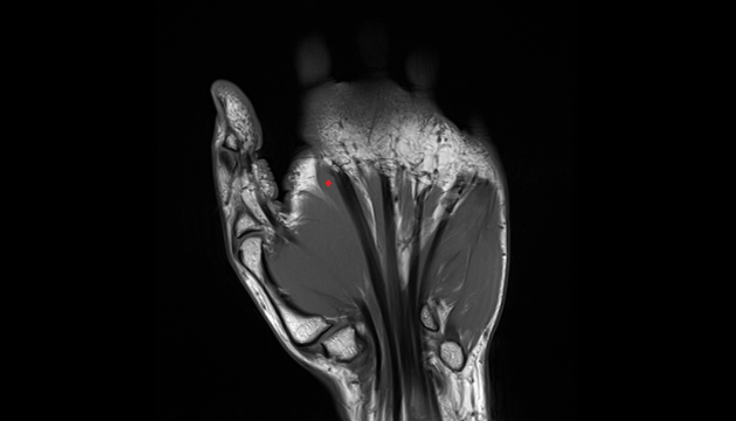 First lumbrical  muscle of hand of hand coronal cross sectional anatomy 3T MRI AI enhanced radiology image-img-00000-00000
