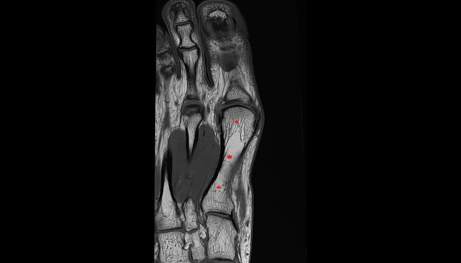 First metatarsal bone axial cross sectional anatomy 3T MRI AI enhanced radiology image-img-00000-00000