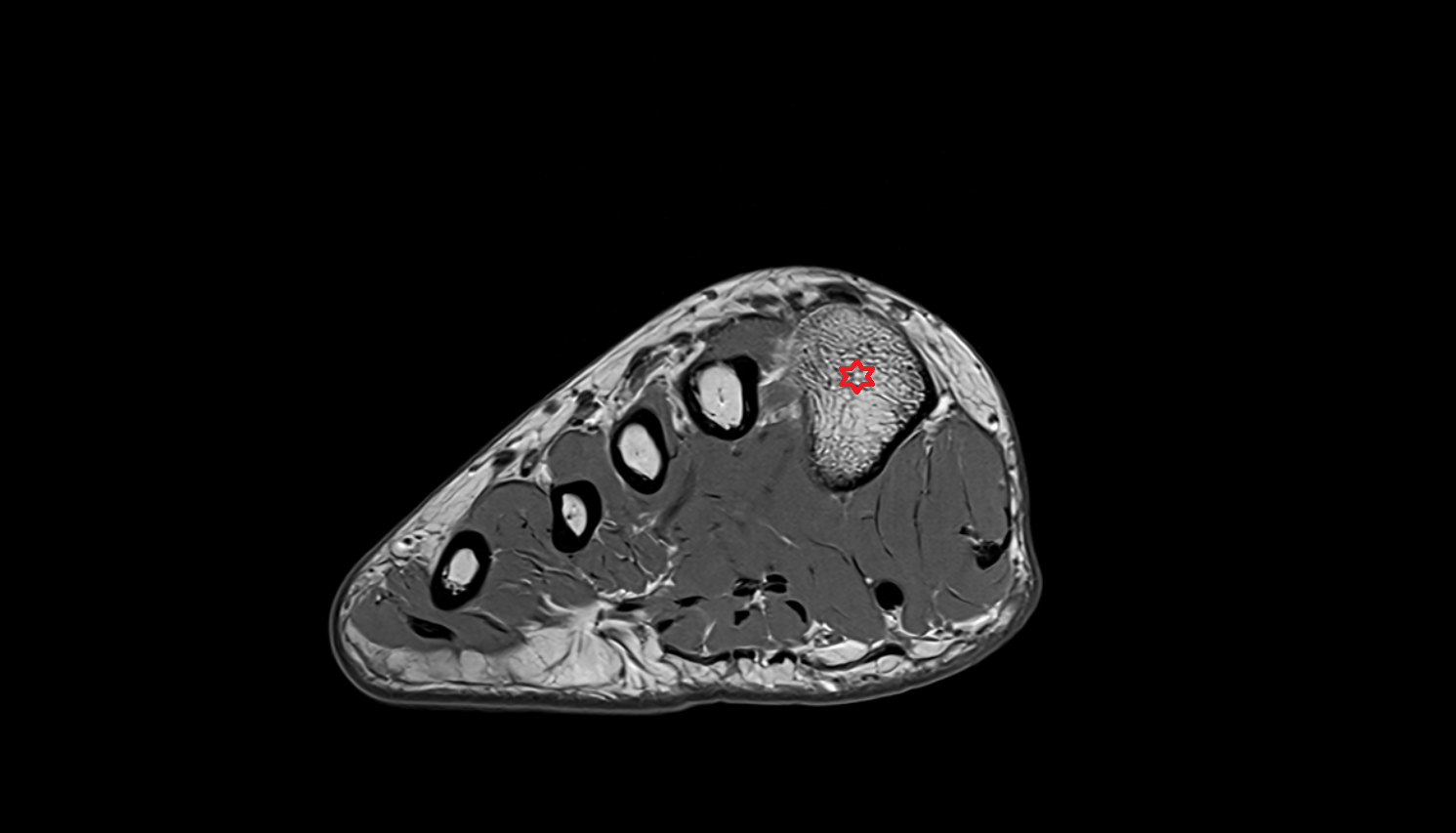 First metatarsal bone axial cross sectional anatomy 3T MRI AI enhanced radiology image-img-00000-00000_00001