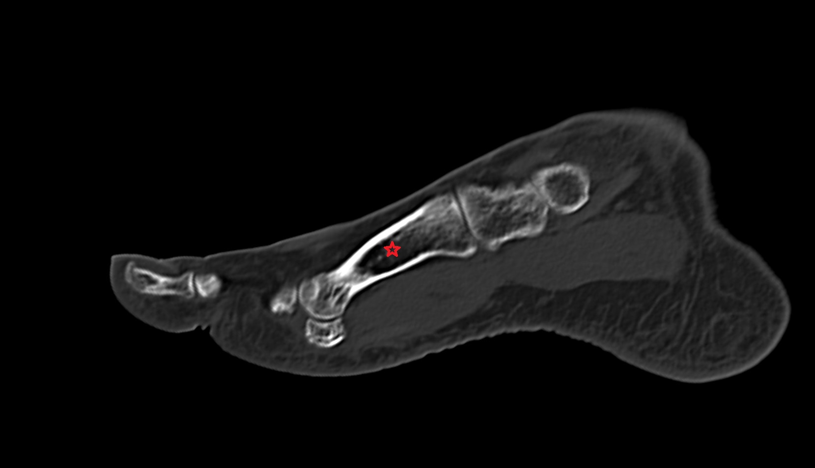 First metatarsal bone ct sagittal image