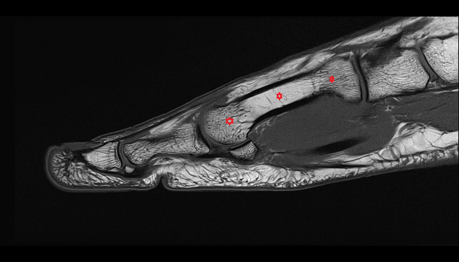 First metatarsal bone sah cross sectional anatomy 3T MRI AI enhanced radiology image-img-00000-00000
