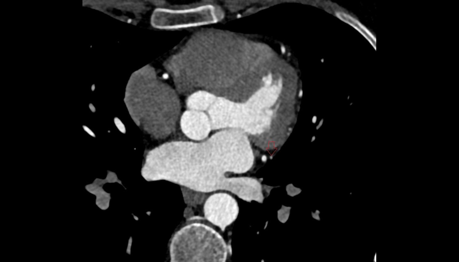First obtuse marginal branch  CT  axial image -img-00000-00000
