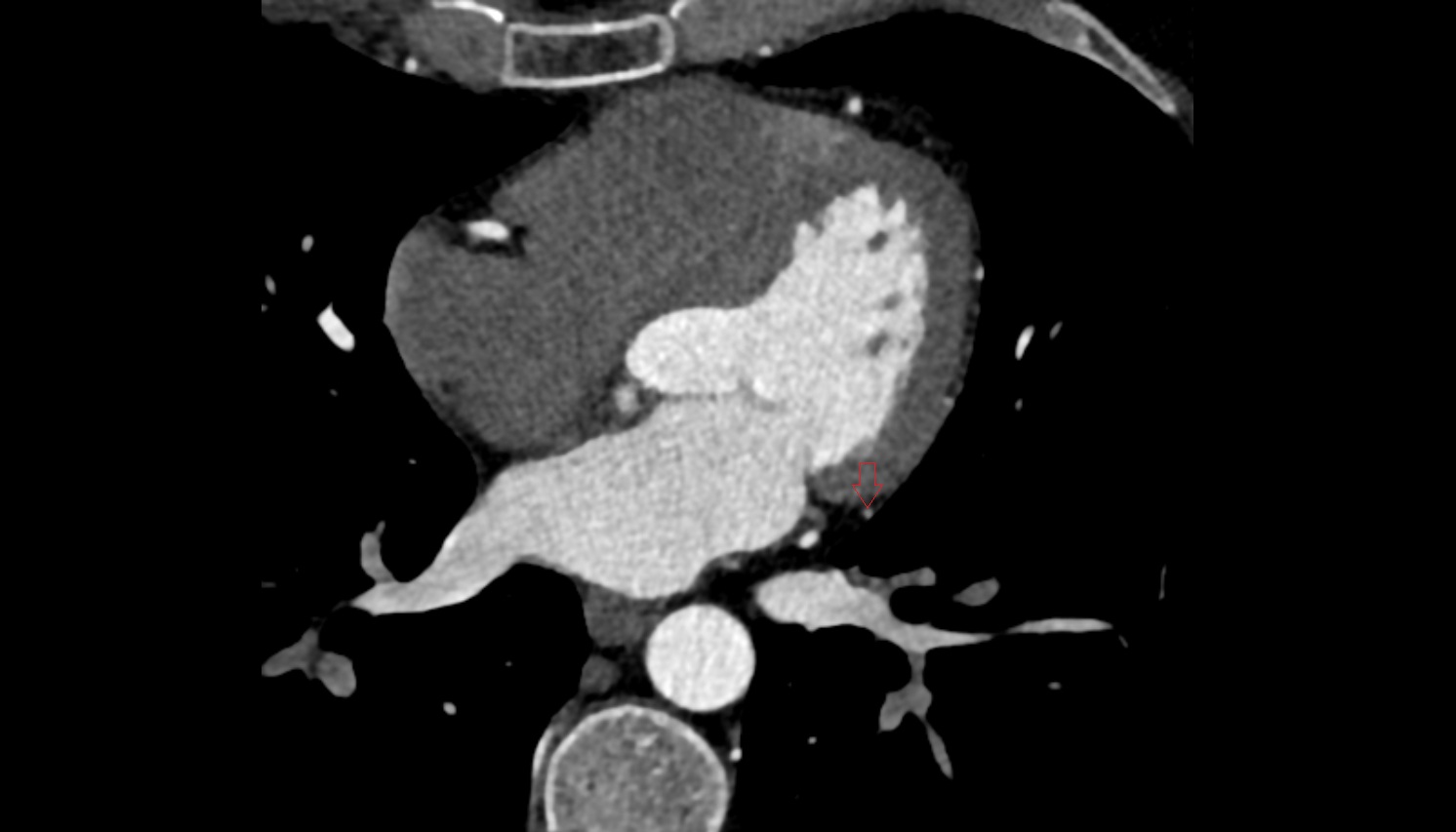 First obtuse marginal branch  CT  axial image -img-00000-00000_00001