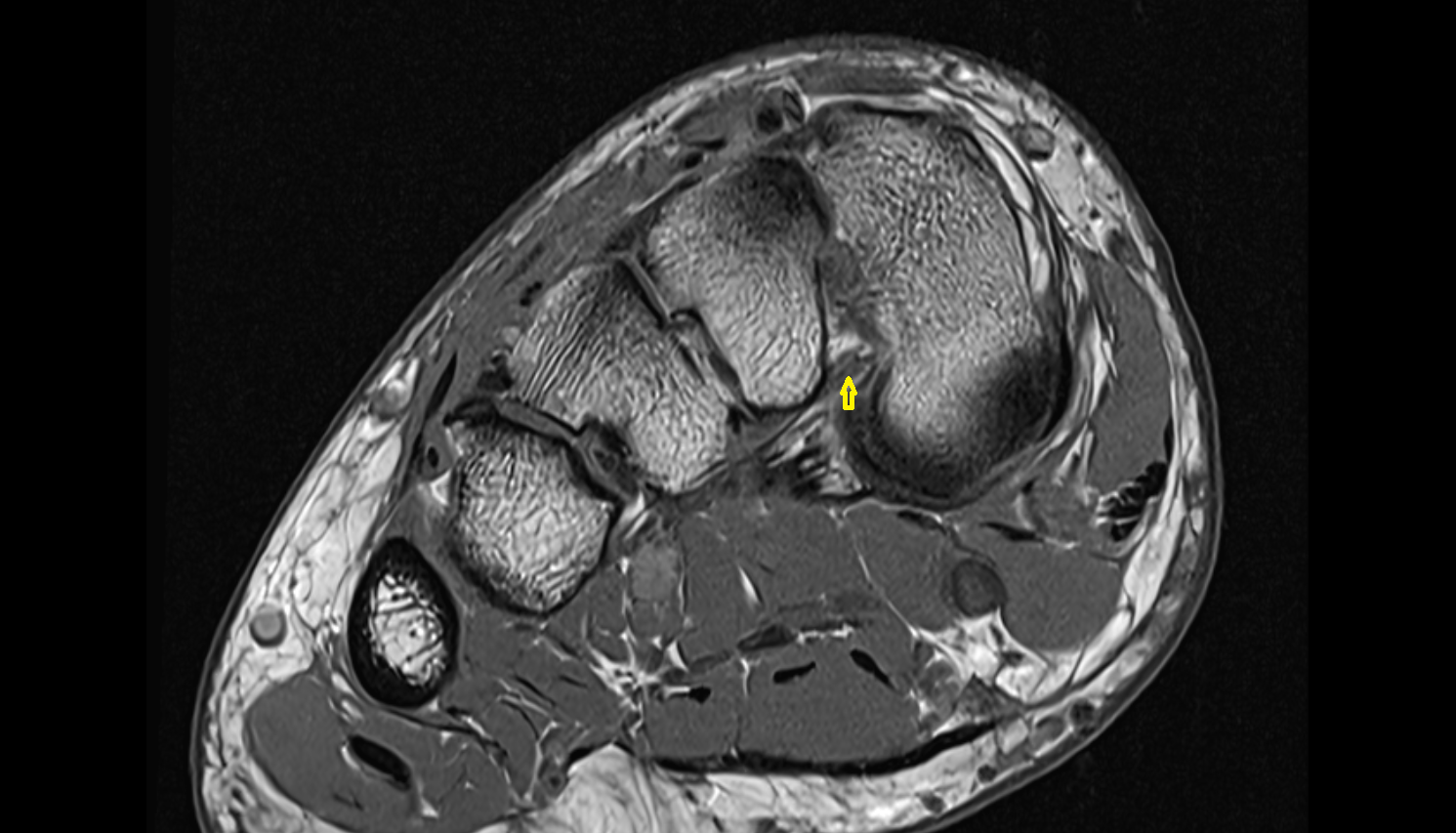 First plantar cuneometatarsal ligament (Plantar  lisfranc ligament) axial cross sectional anatomy 3T MRI AI enhanced radiology image-img-00000-00000