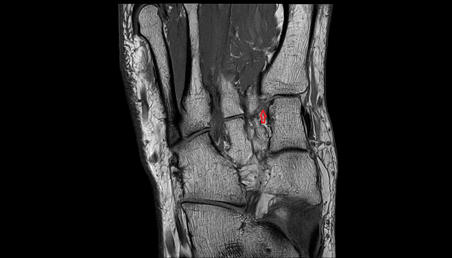 First plantar cuneometatarsal ligament (Plantar  lisfranc ligament) coronal cross sectional anatomy 3T MRI AI enhanced radiology image-img-00000-00000_00001