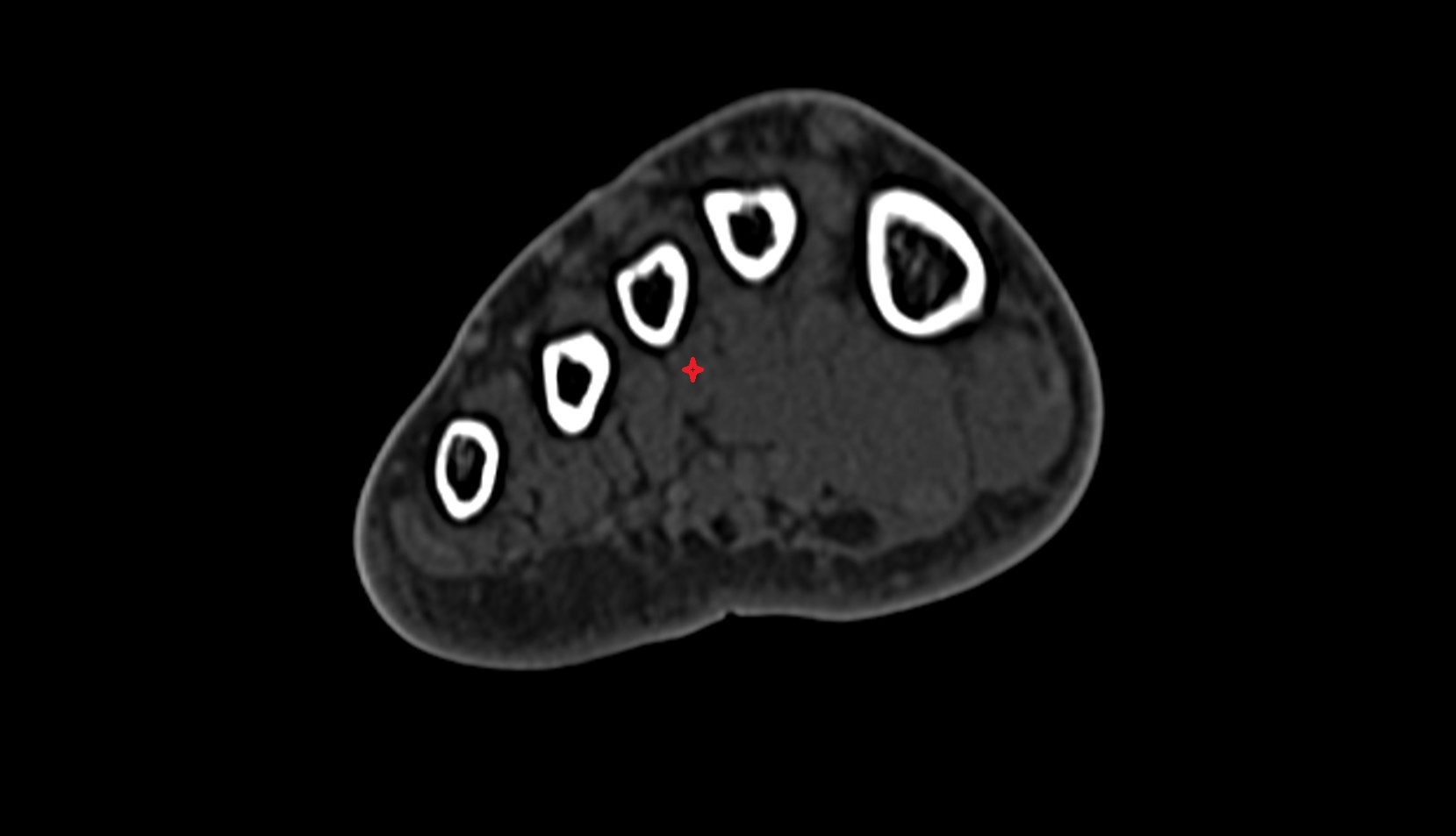 First plantar interosseous muscle of foot axial ct image